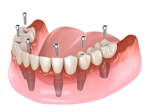 all on 4 dental implants full arch fixed bridge north york