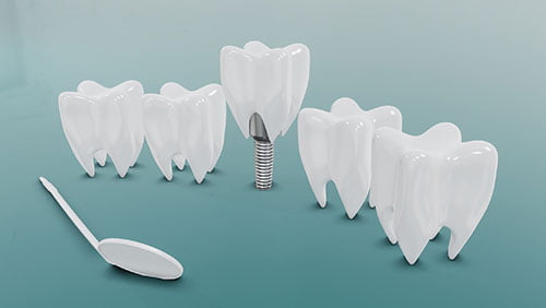 dental implants needed missing teeth dentures problems