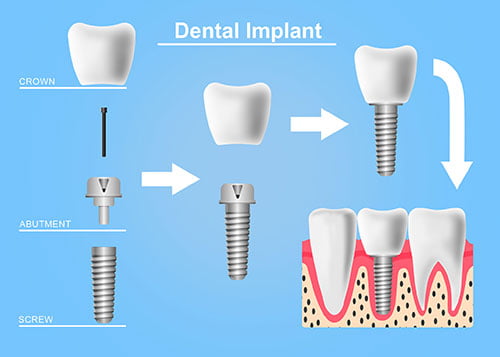 dental implant replaces tooth root bone integration stability