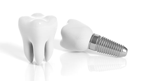missing tooth bone loss progression shifting teeth jaw changes