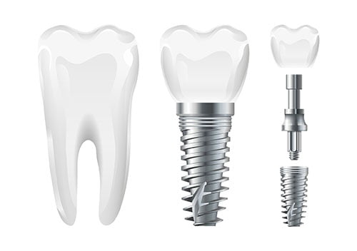 missing tooth impact bite bone loss dental implants north york