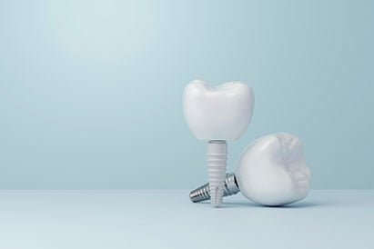 Dental Implants