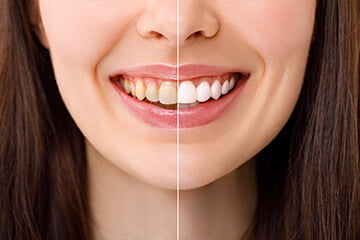 Will teeth whitening work for me?