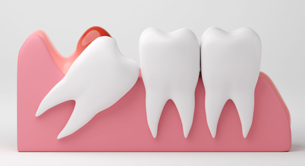 Is Wisdom Teeth Removal Covered by CDCP?