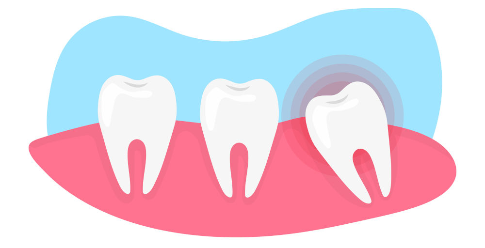 How Much Does Wisdom Tooth Removal Cost in Ontario?
