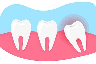 How Much Does Wisdom Tooth Removal Cost in Ontario?
