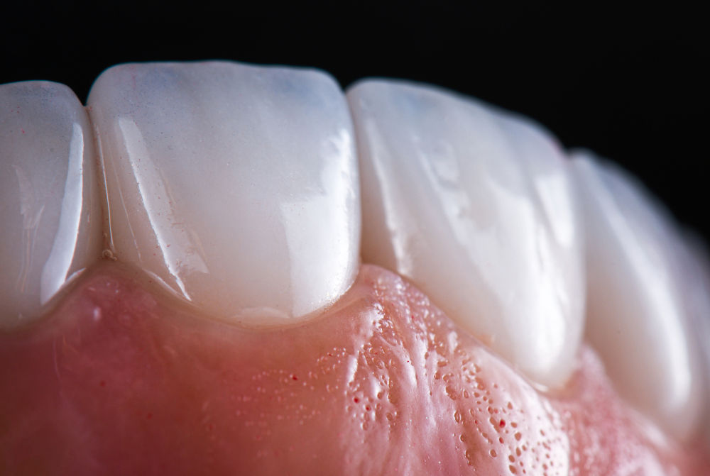 E-max ceramic porcelain veneers and crowns are used for smile makeover treatments in cosmetic dentistry.