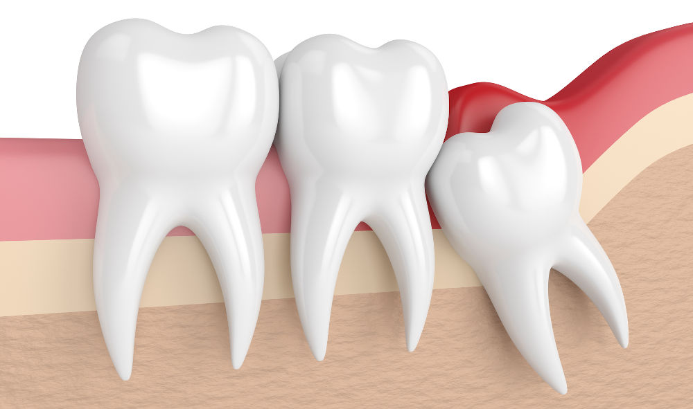 3D render of an impacted wisdom tooth illustrating why surgical extraction is more complex and costly than simple removal in Ontario dental clinics.