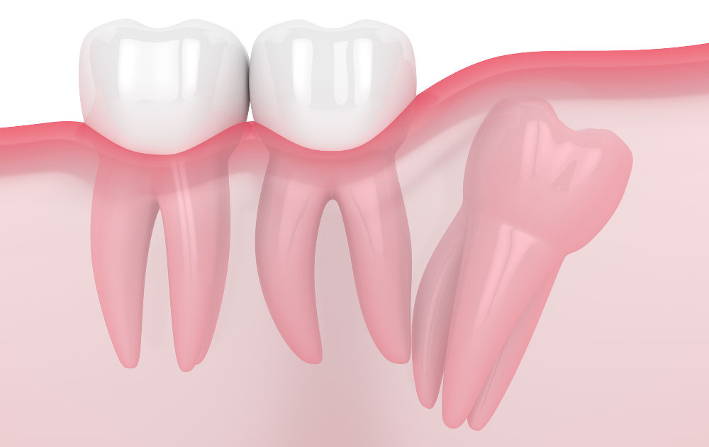 3D illustration of a lower impacted wisdom tooth showing proximity to nerves and increased surgical complexity affecting removal costs in Ontario.
