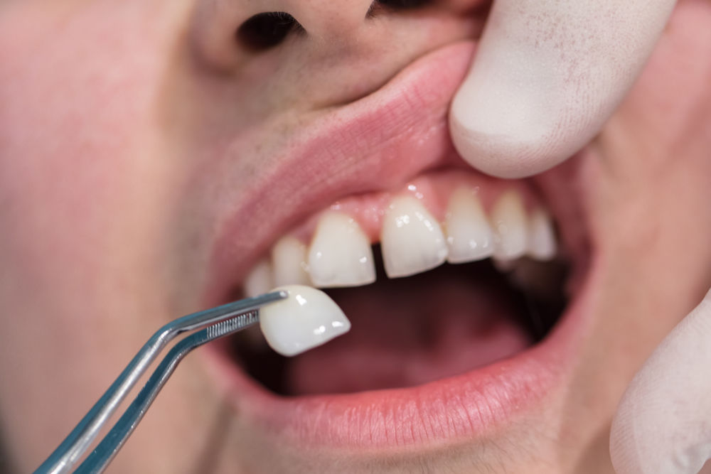 Close-up of a ceramic dental veneer restoration used in cosmetic dentistry to improve tooth colour, shape, and symmetry.