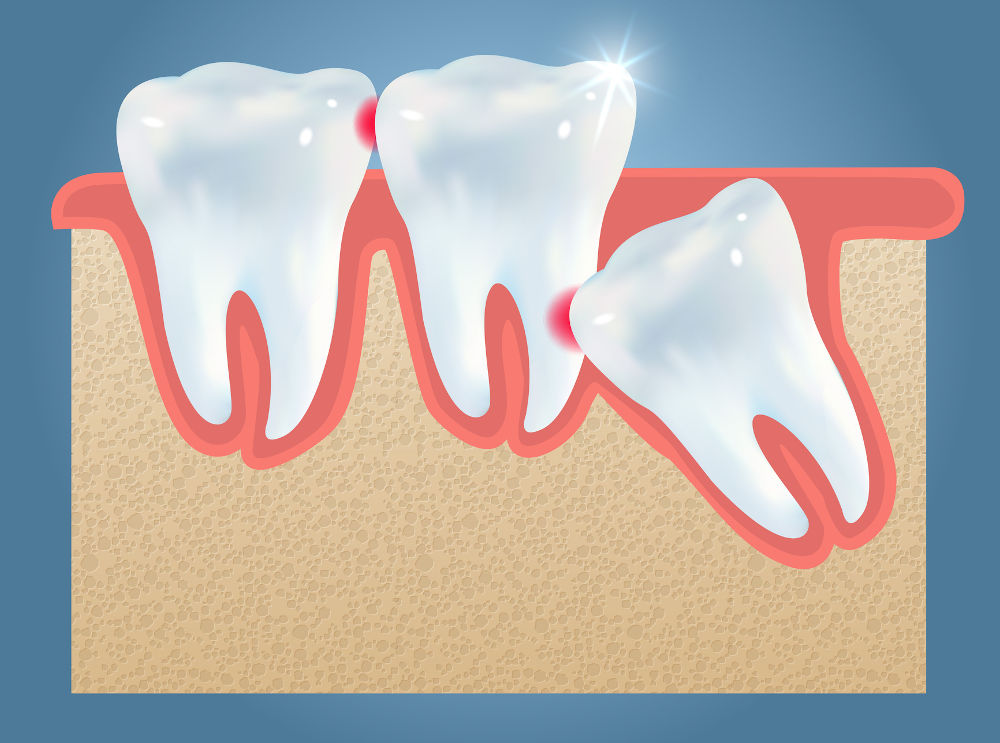 Illustration highlighting common wisdom teeth problems and the importance of budgeting and financing options for dental surgery in Ontario.
